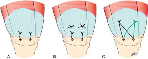 8 mm tear test|Rotator cuff repair: Tear classification, operative techniques, and .